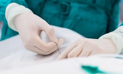 Egy kis medence varikoozus vénáinak diagnosztizálása