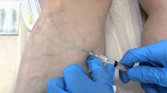 szkleroterápia a lábakon lévő visszér kezelésére nőknél