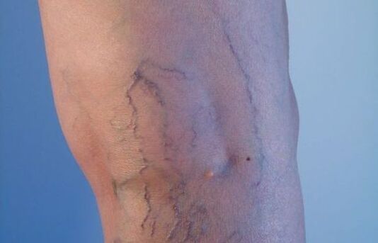 visszér a lábakon nőknél